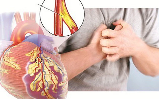 Thuốc lá gây bệnh tim mạch 